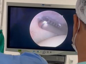 Hospital Estadual do Centro-Norte Goiano realiza primeira cirurgia com alta tecnologia por vídeo